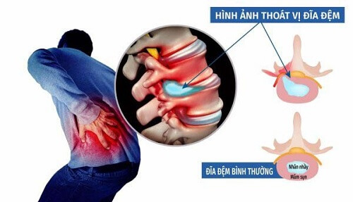 Bệnh thoát vị đĩa đệm có chữa dứt điểm được không ?